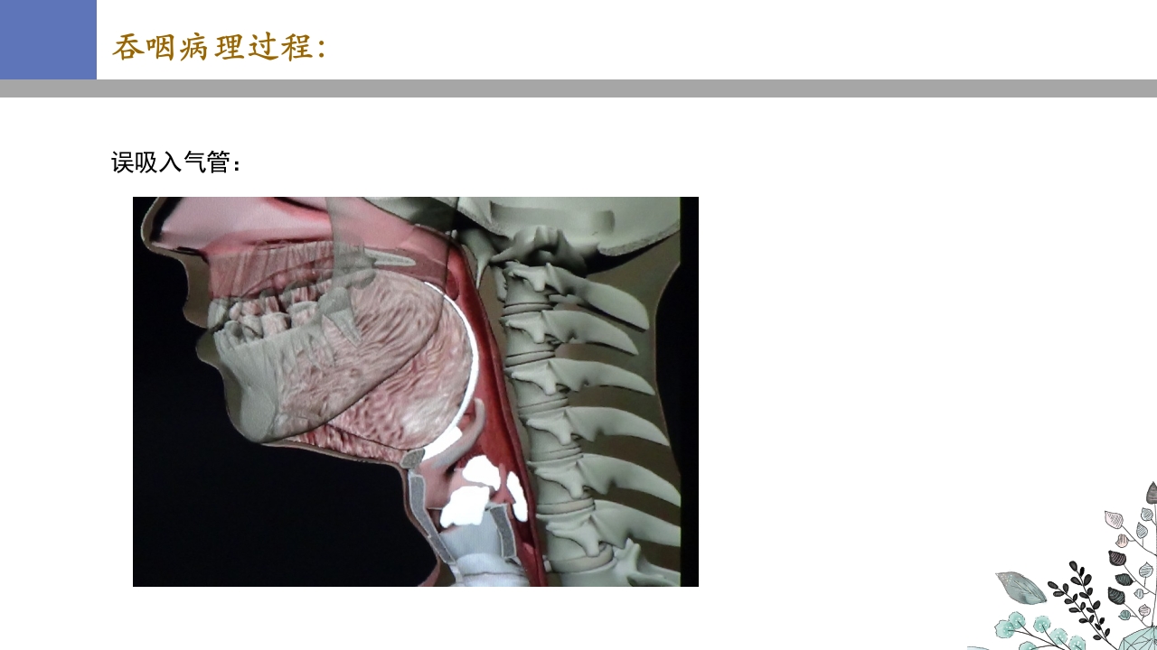 吞咽障碍PPT课件18