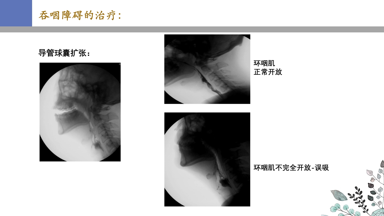 吞咽障碍PPT课件44