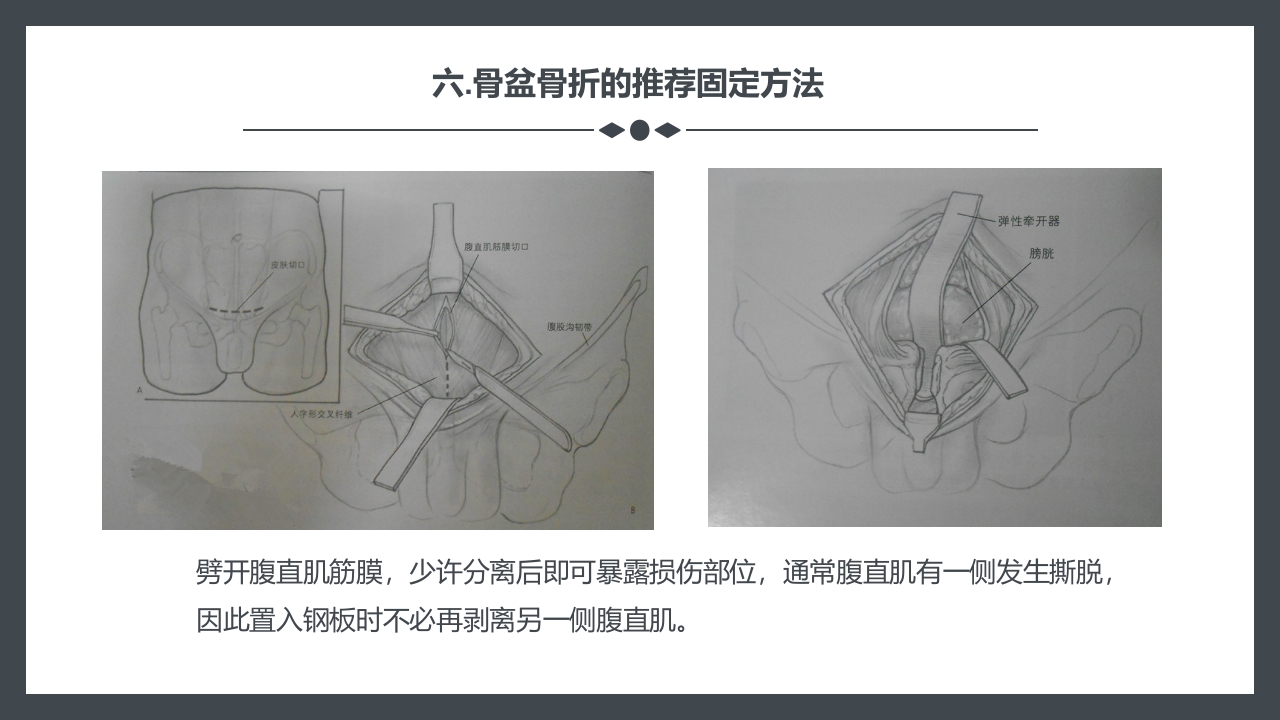 骨盆骨折护理查房PPT课件18