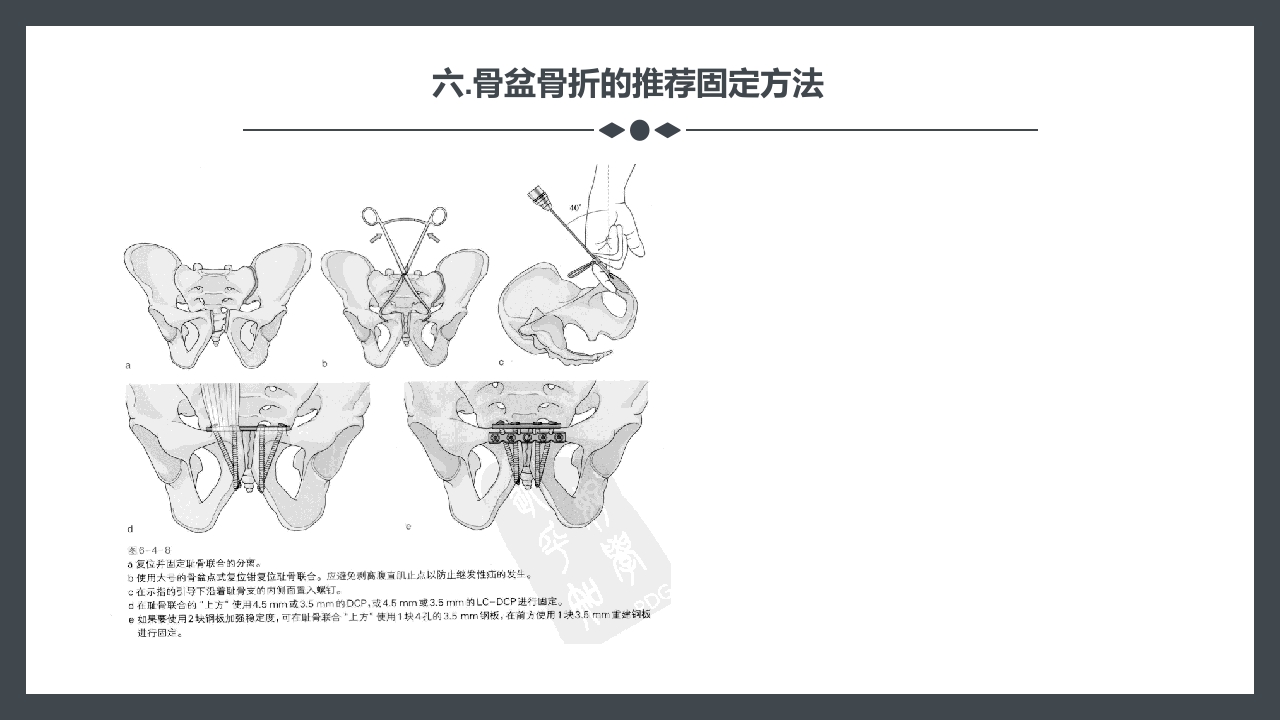 骨盆骨折护理查房PPT课件19
