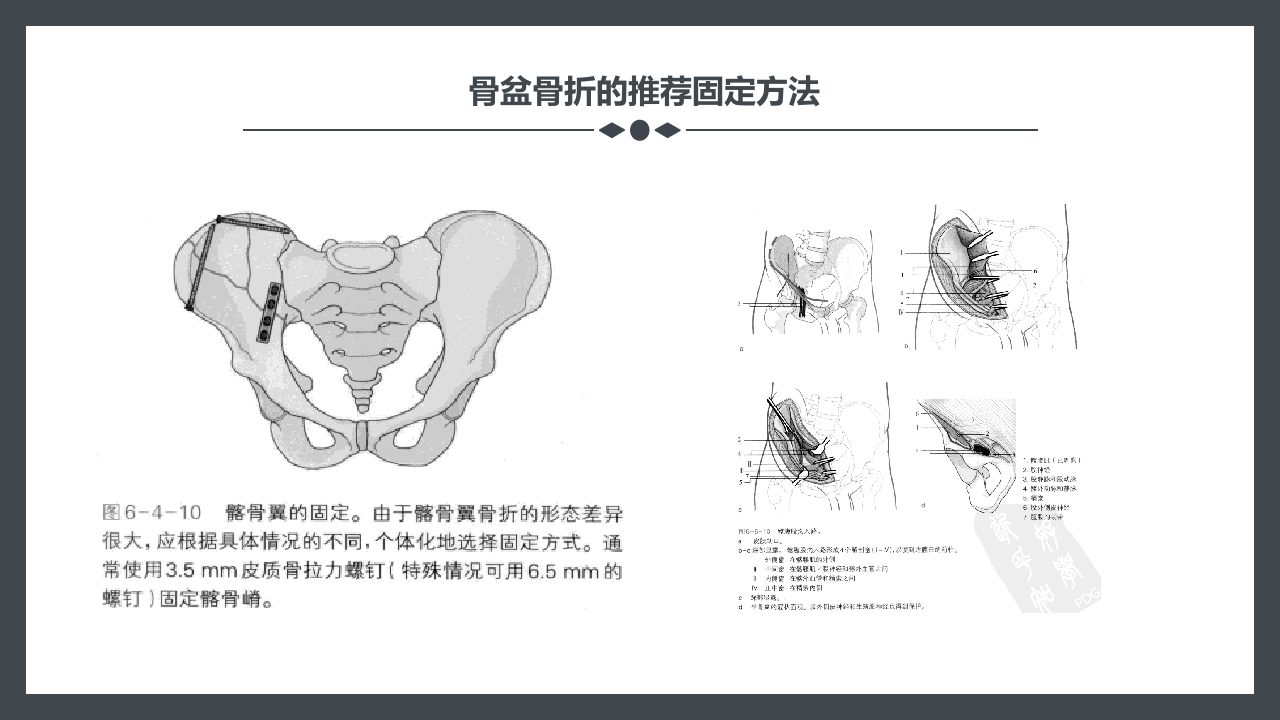 骨盆骨折护理查房PPT课件21