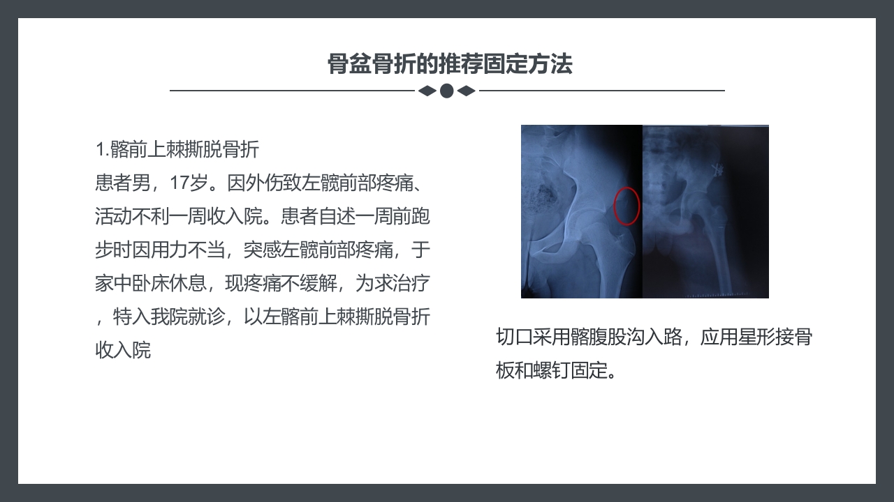 骨盆骨折护理查房PPT课件26