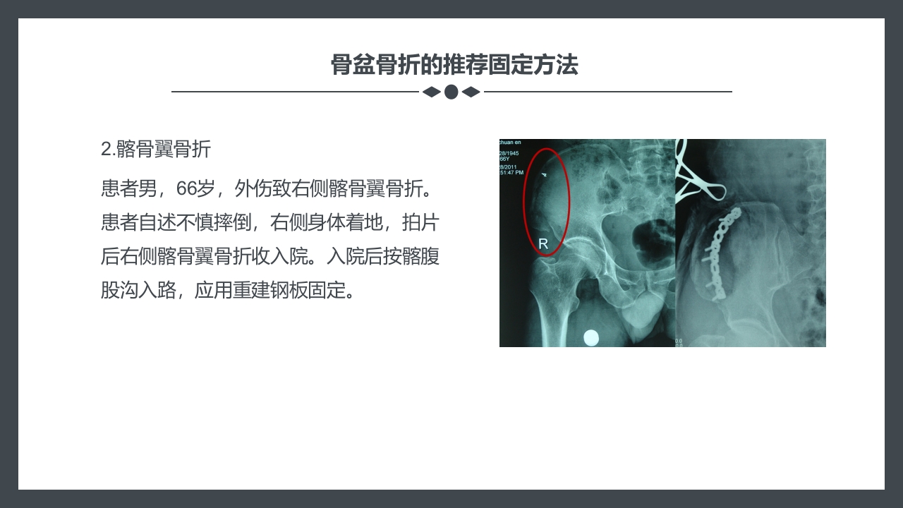 骨盆骨折护理查房PPT课件27