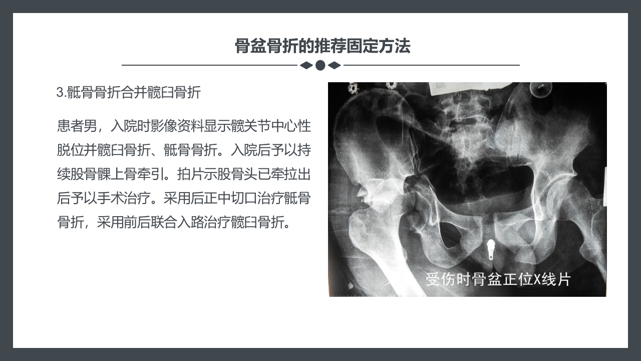 骨盆骨折护理查房PPT课件28