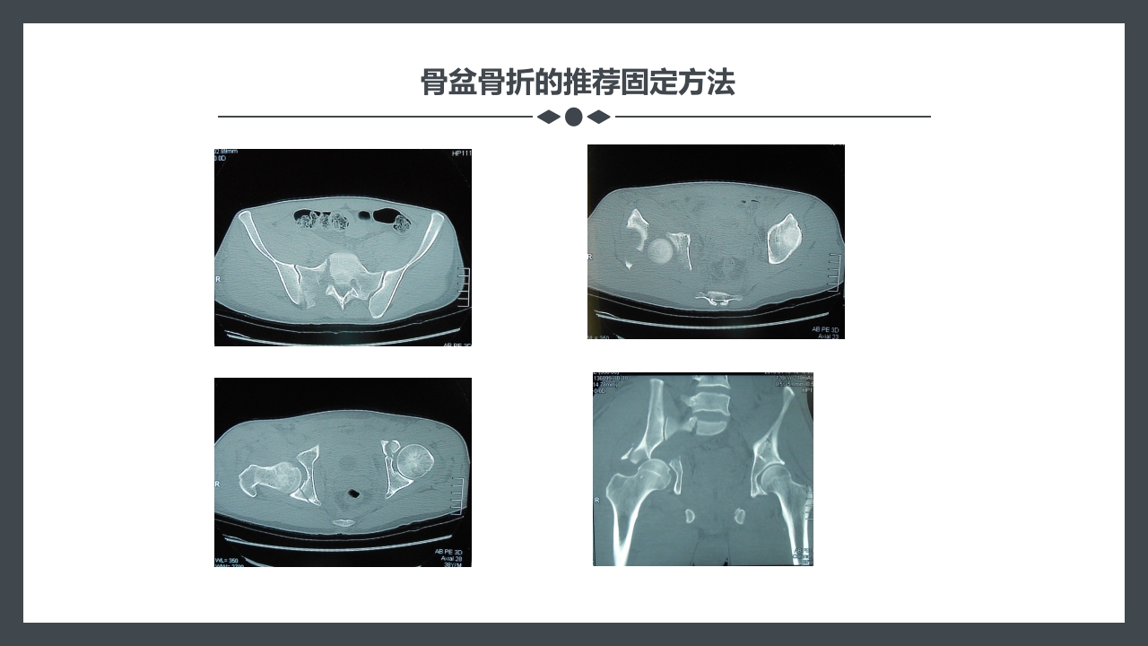 骨盆骨折护理查房PPT课件29