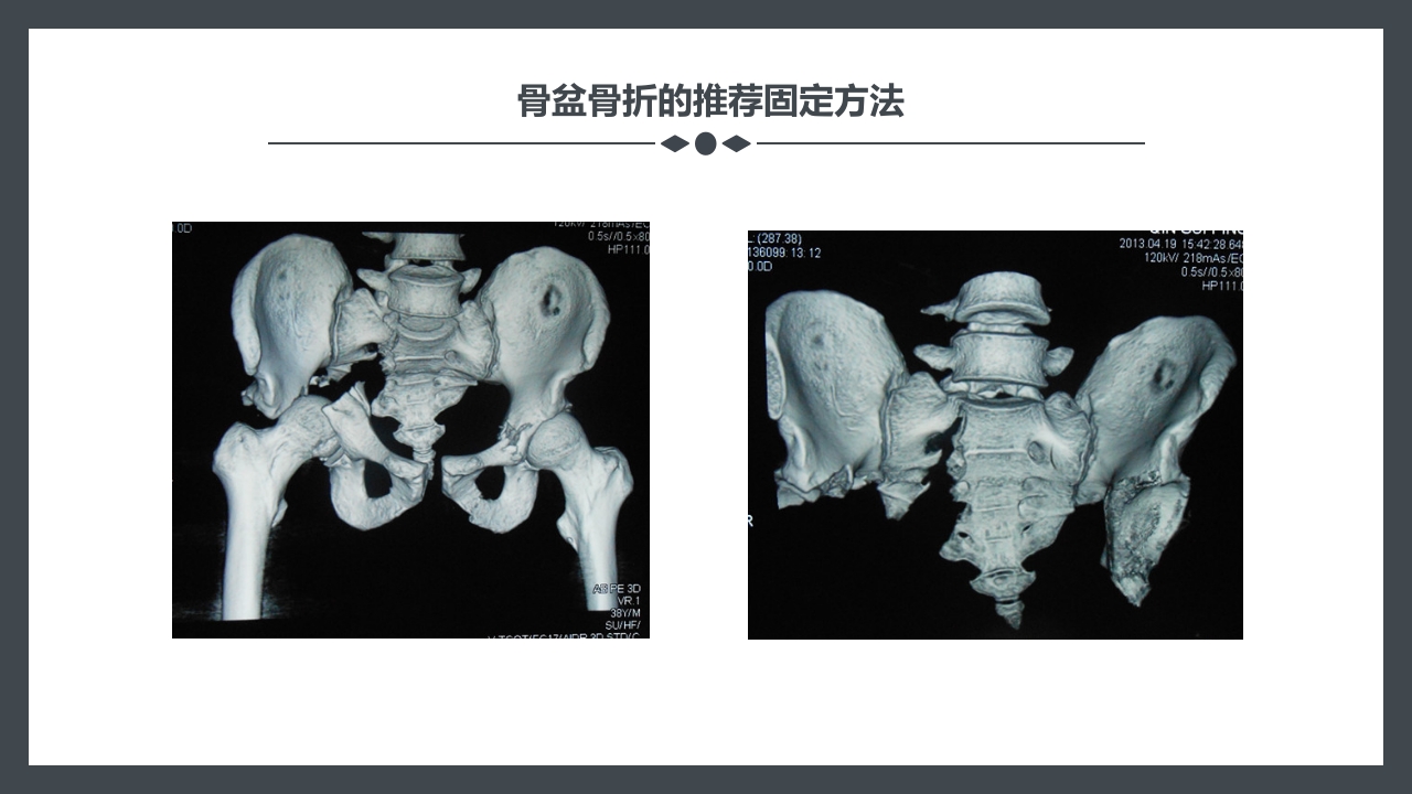 骨盆骨折护理查房PPT课件30