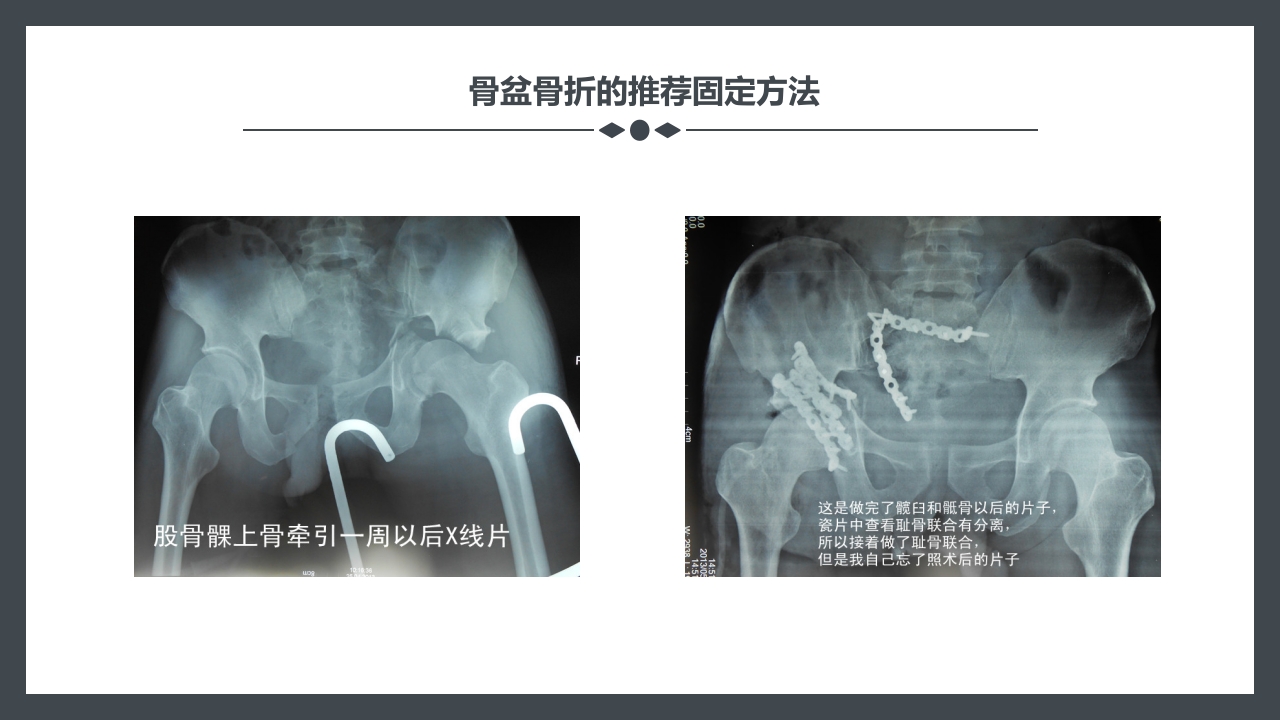骨盆骨折护理查房PPT课件31