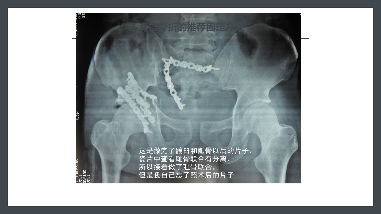 骨盆骨折护理查房PPT课件32