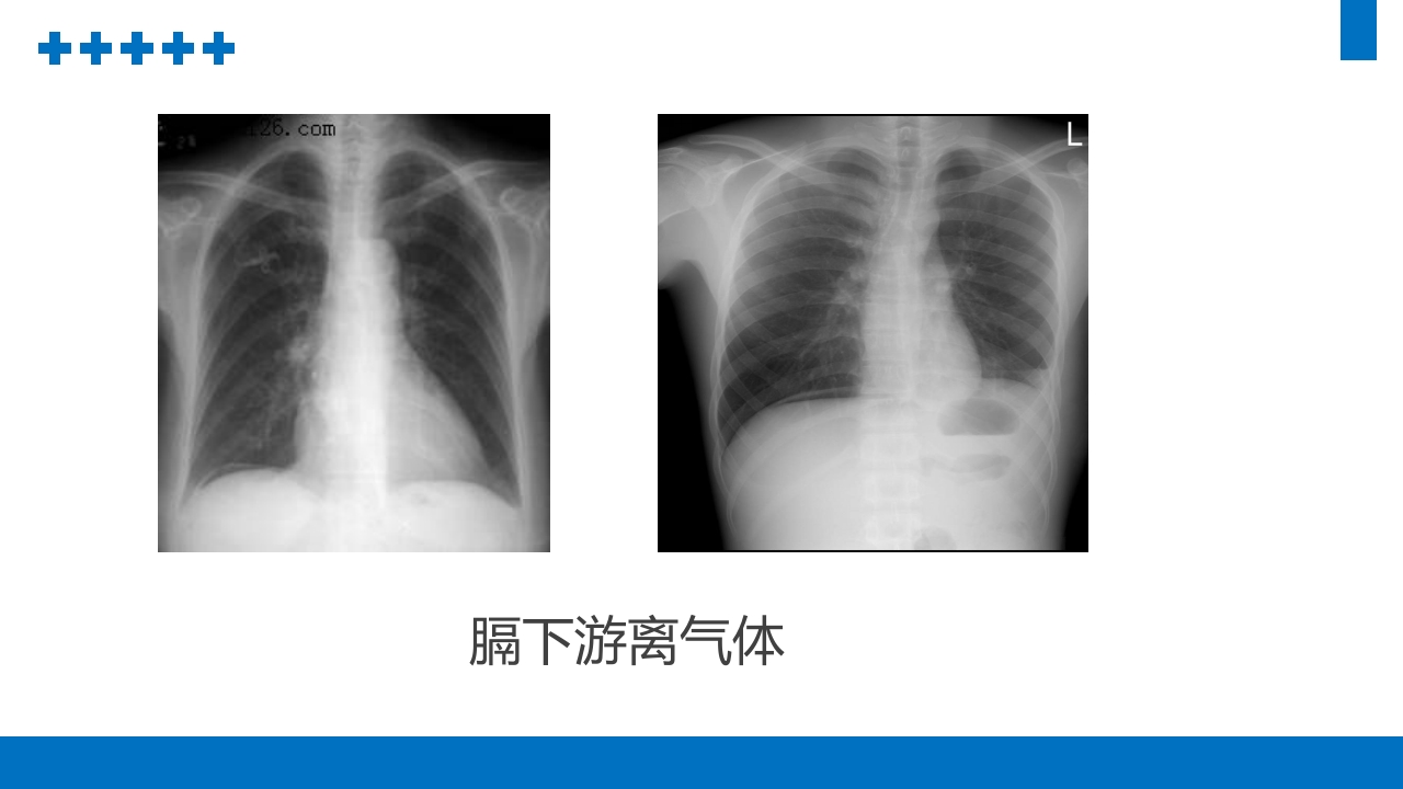 消化道穿孔PPT课件9