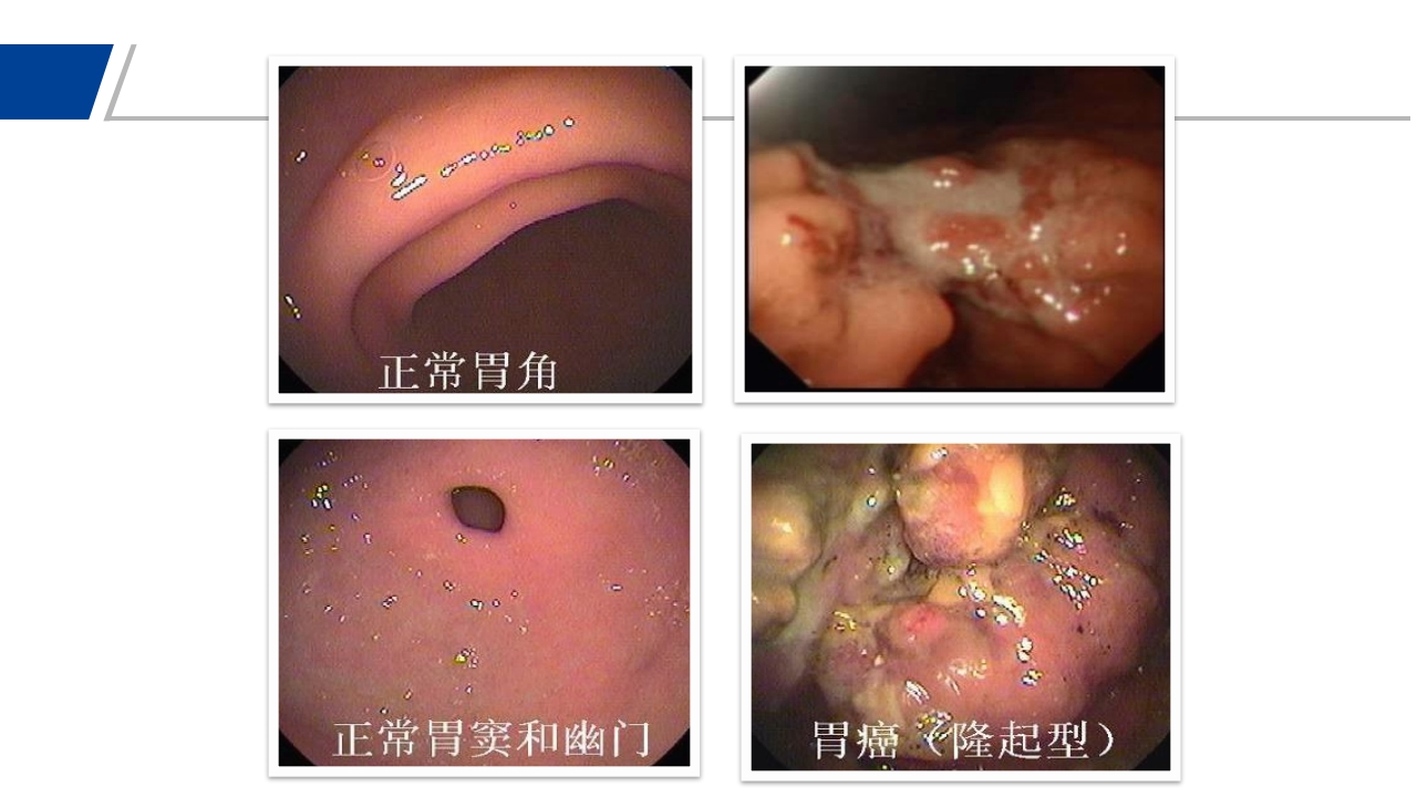 胃癌PPT课件15