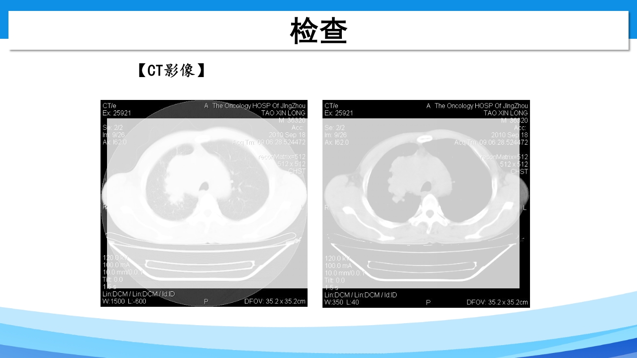 上腔静脉综合征PPT课件17