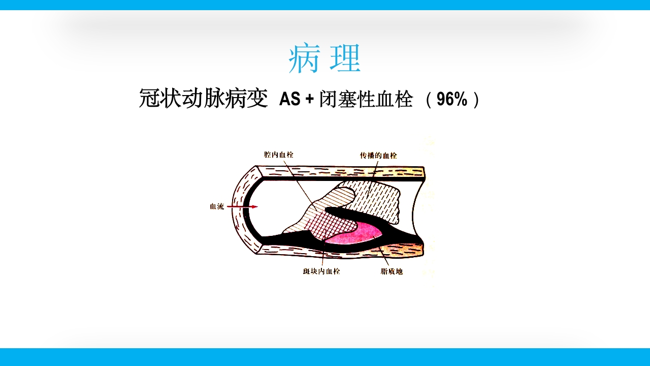 老年心绞痛PPT课件15
