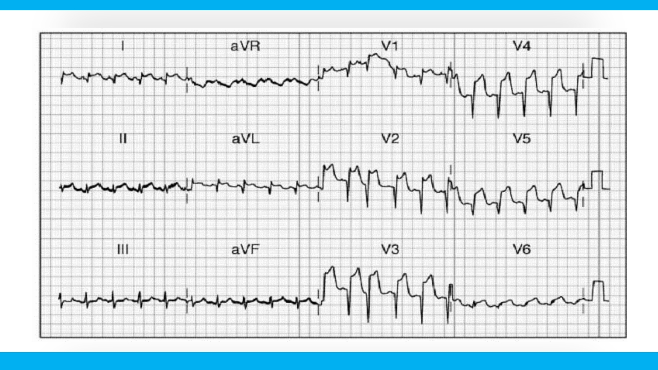 老年心绞痛PPT课件19