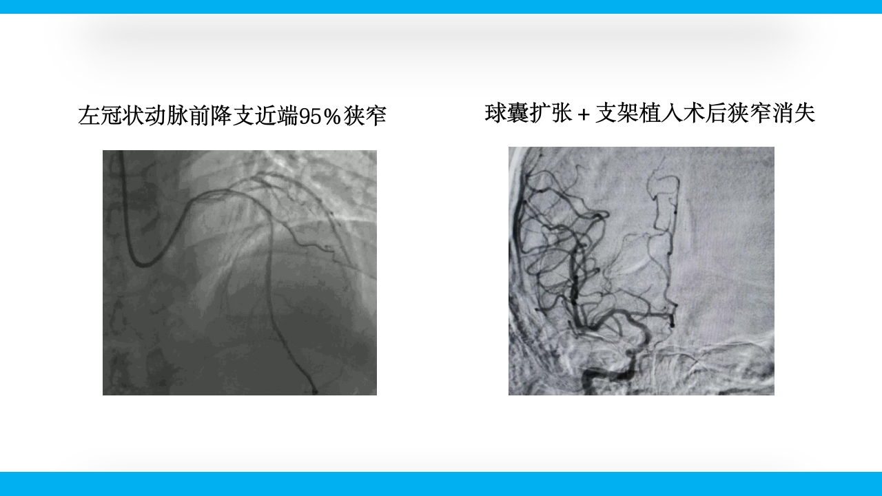 老年心绞痛PPT课件36