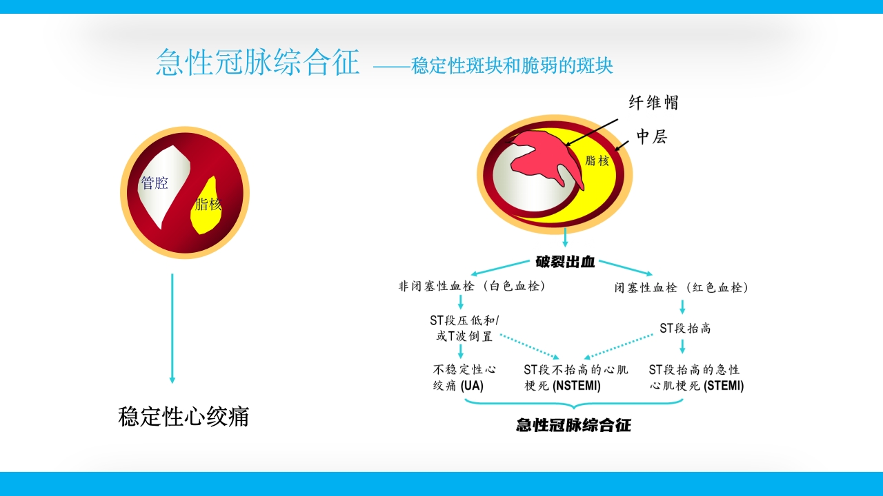 老年心绞痛PPT课件39