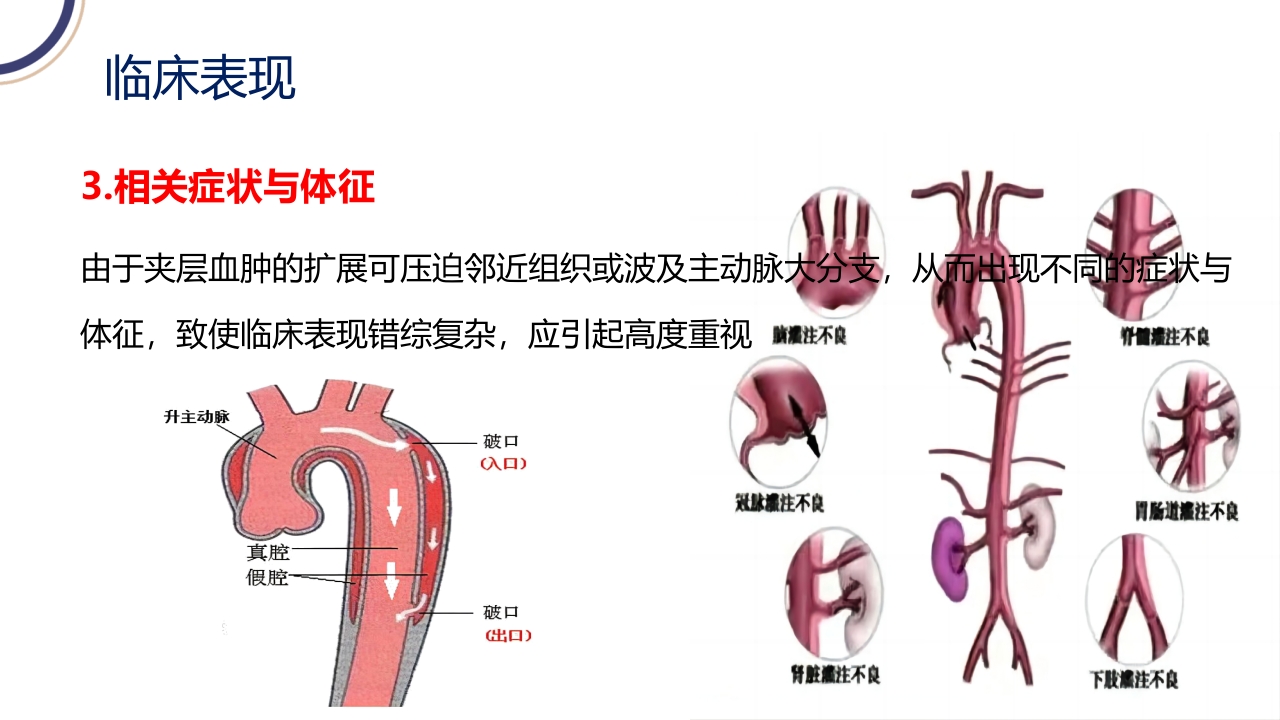 主动脉夹层PPT课件15