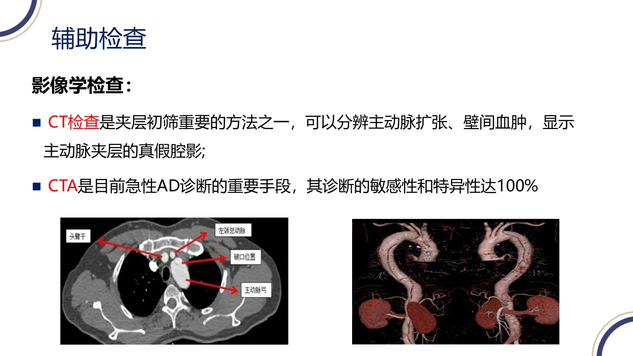主动脉夹层PPT课件19