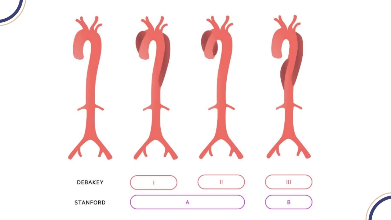 主动脉夹层PPT课件24