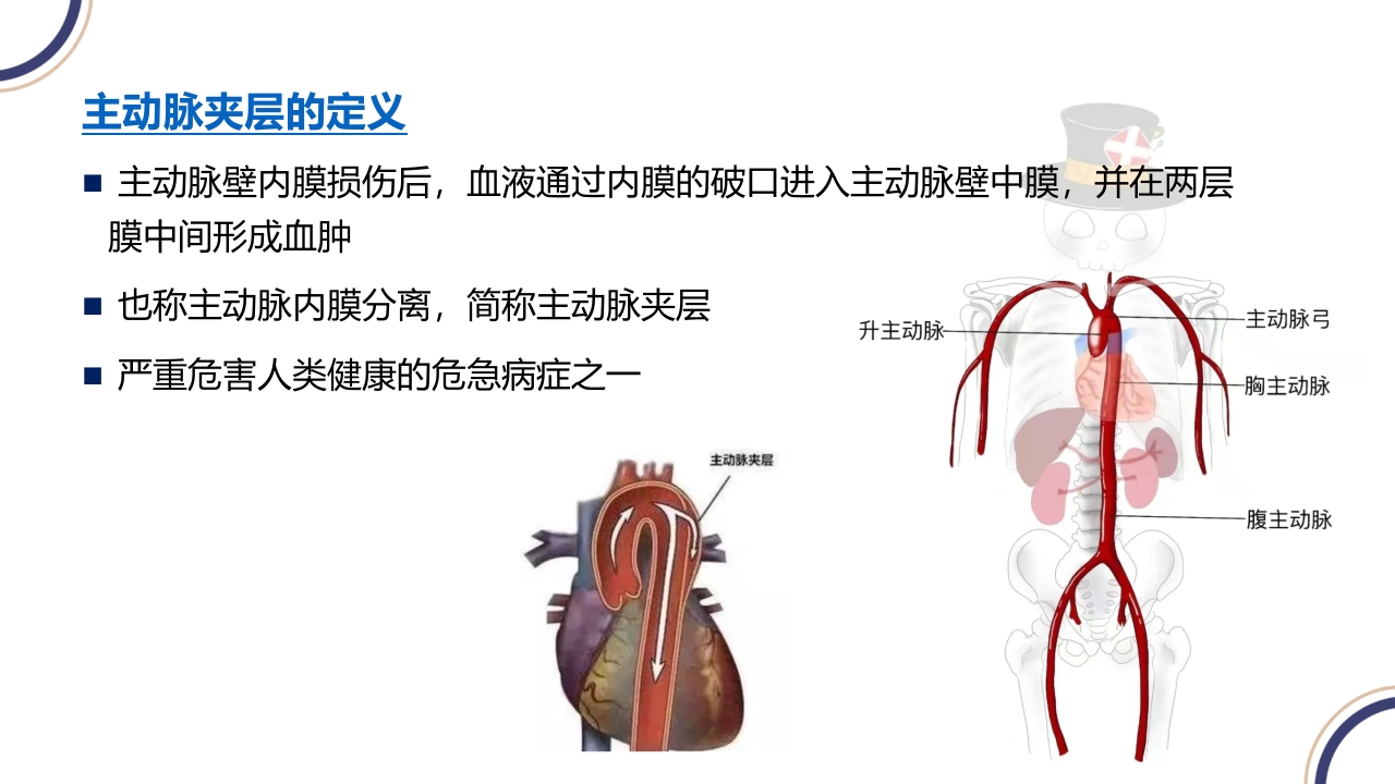 主动脉夹层PPT课件5