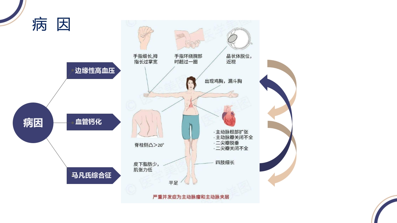 主动脉夹层PPT课件6