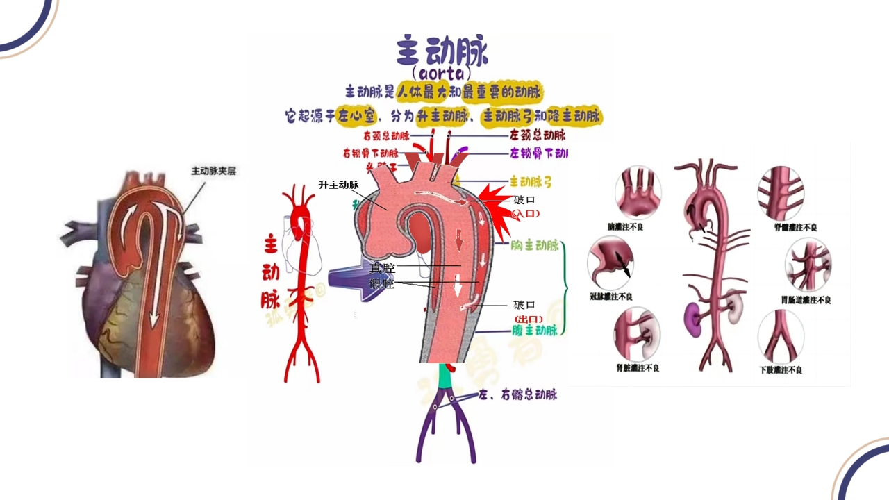 主动脉夹层PPT课件8