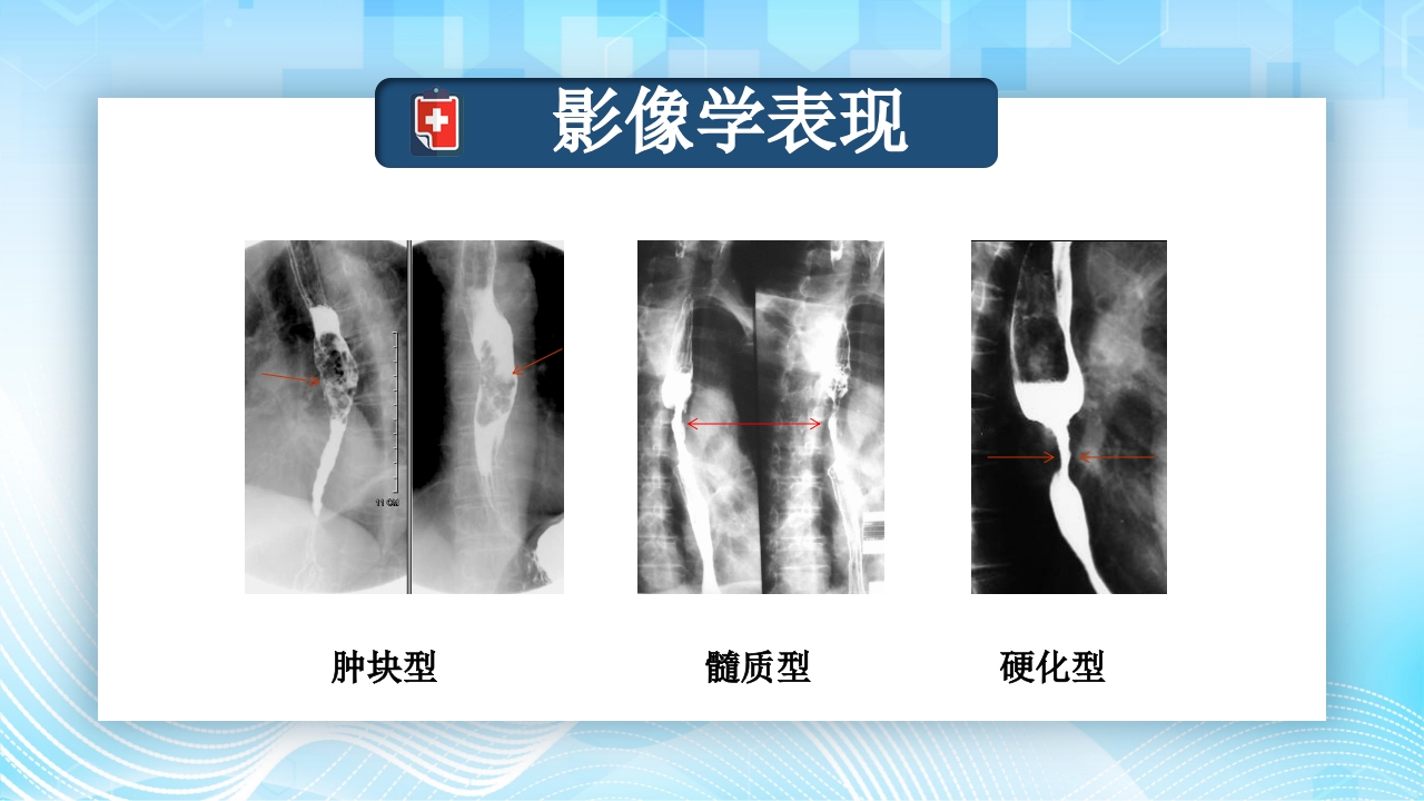 食管癌的护理查房PPT课件14