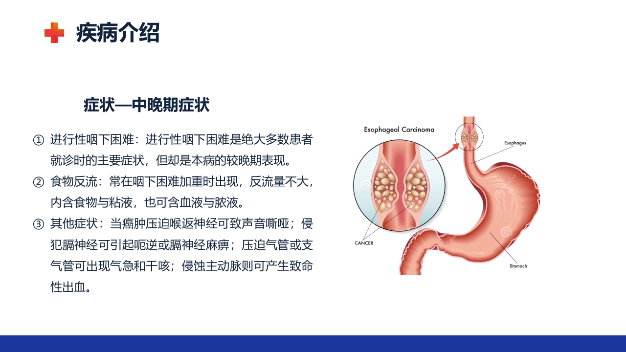 食管癌的护理查房ppt课件10