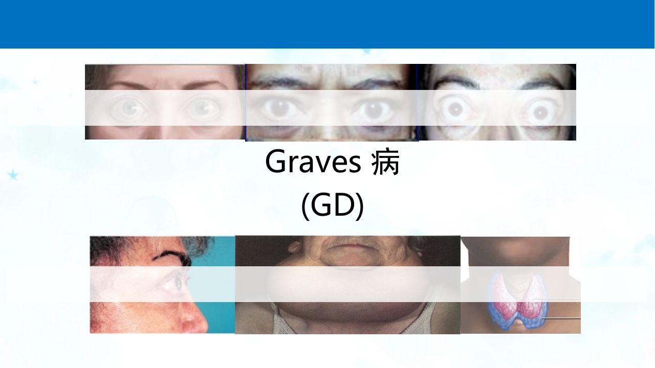甲亢PPT课件8