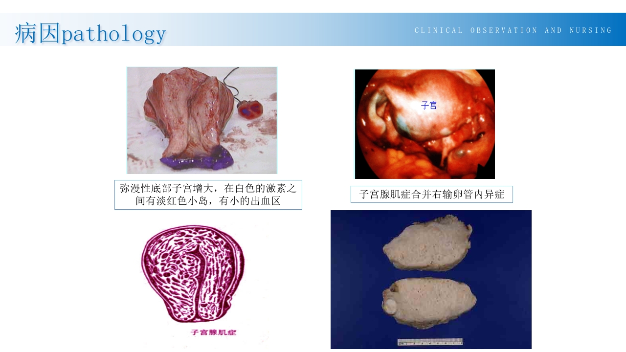 子宫腺肌症诊断及治疗PPT课件11
