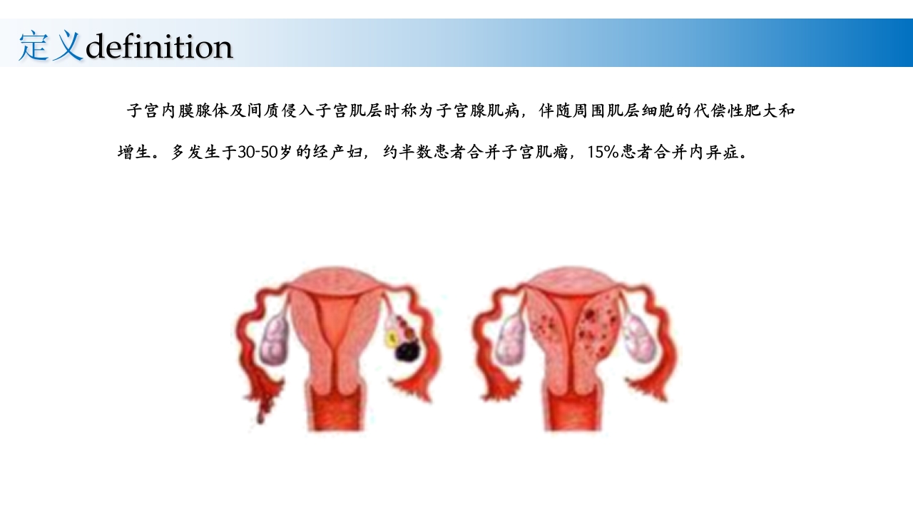 子宫腺肌症诊断及治疗PPT课件8