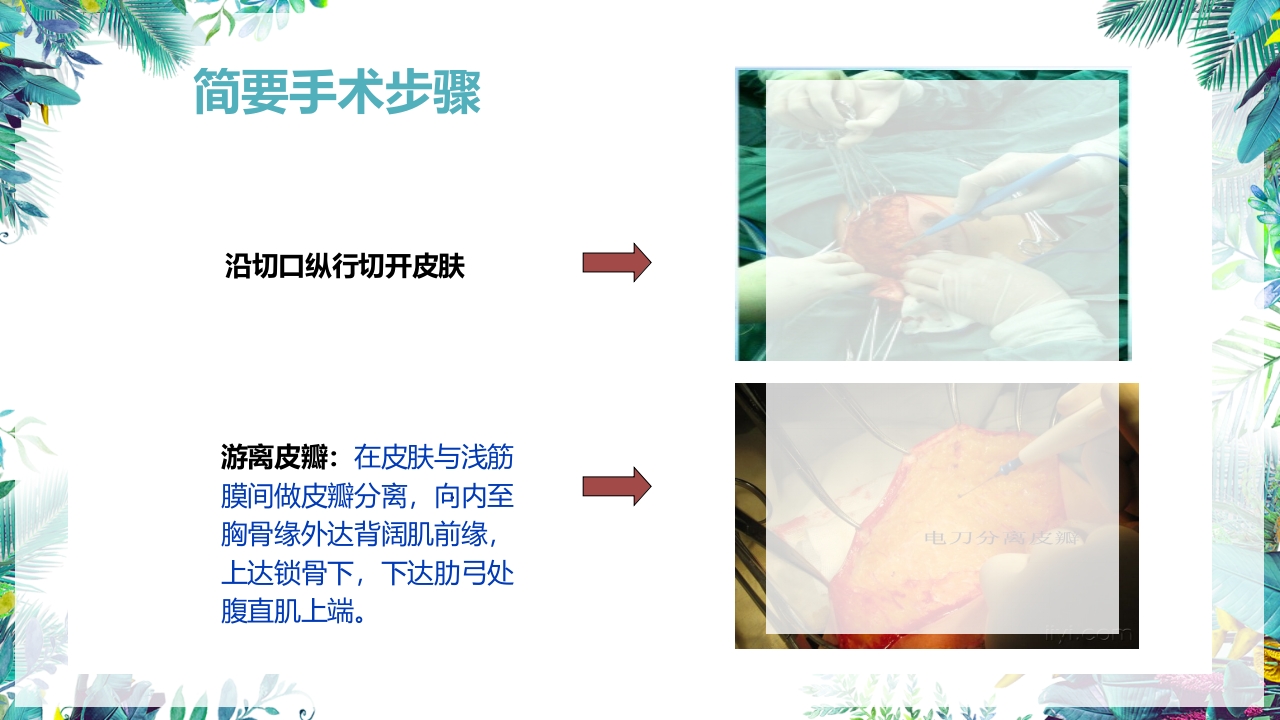 乳癌改良根治术护理配合PPT课件16