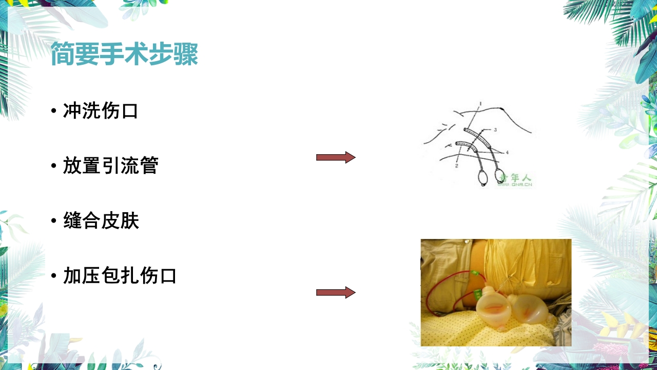 乳癌改良根治术护理配合PPT课件18