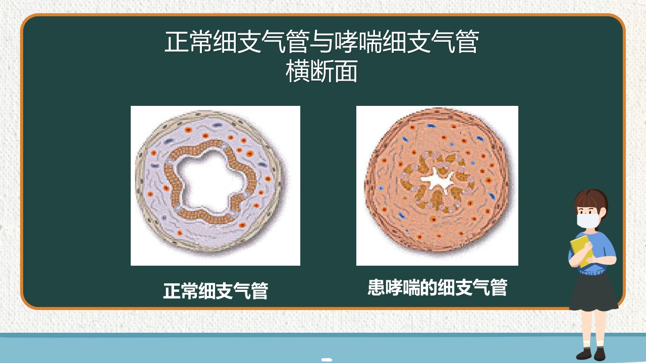 支气管哮喘健康教育PPT课件7