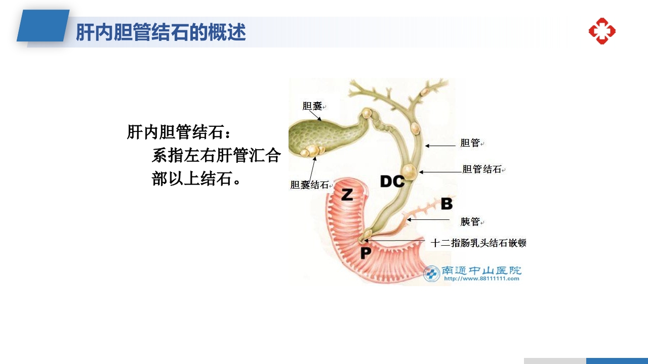 肝内胆管结石护理查房PPT课件11