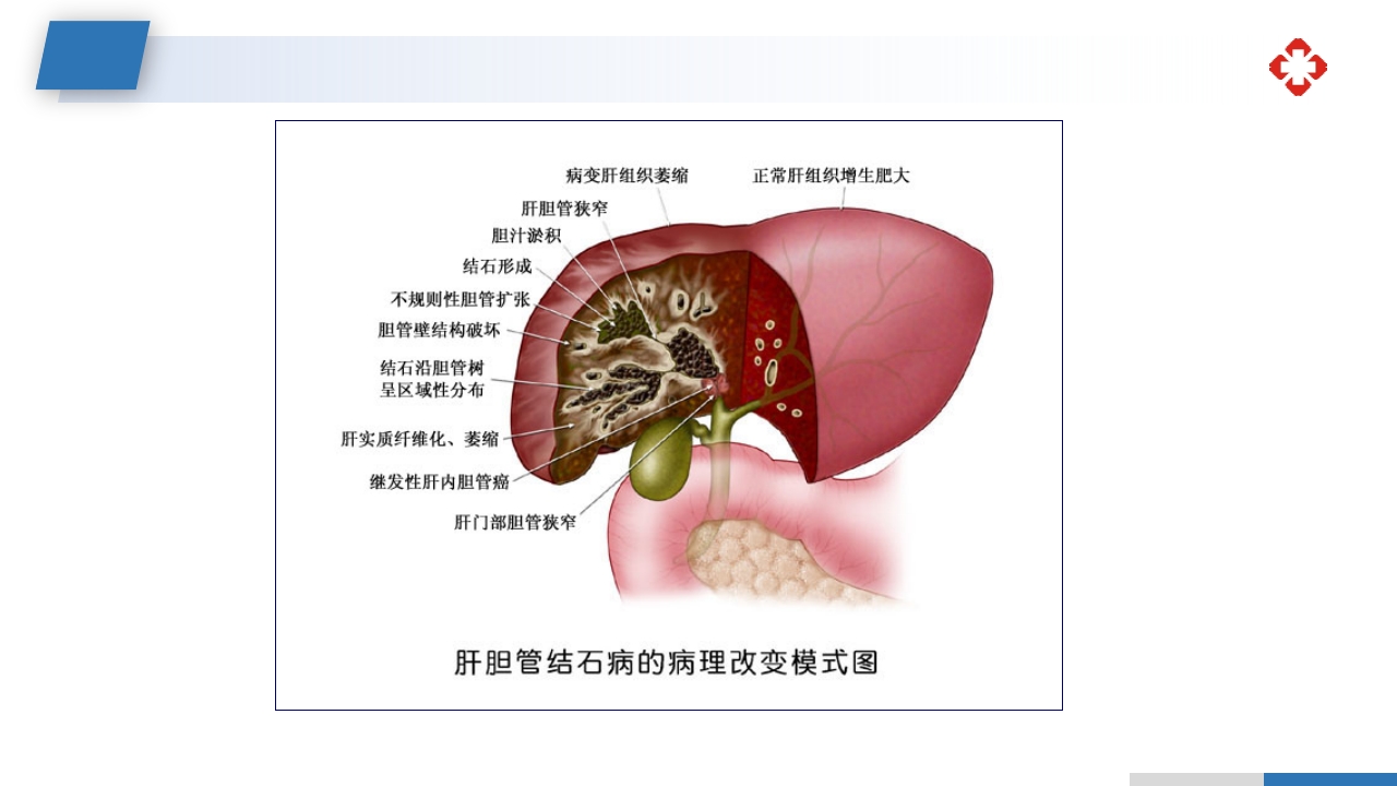 肝内胆管结石护理查房PPT课件12