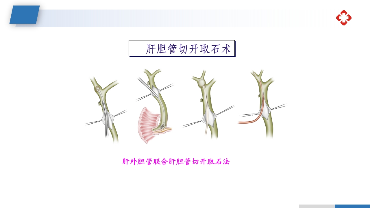 肝内胆管结石护理查房PPT课件21