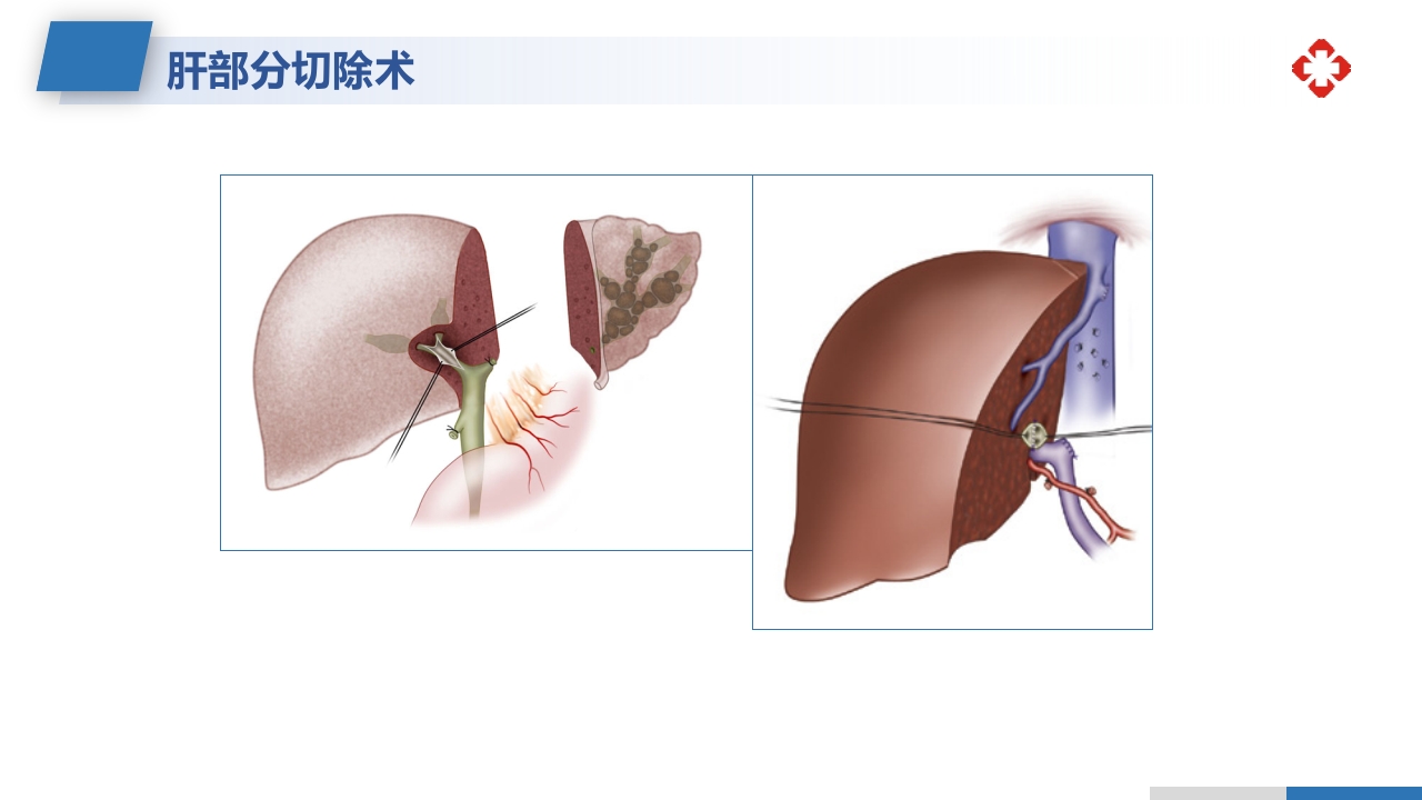 肝内胆管结石护理查房PPT课件22