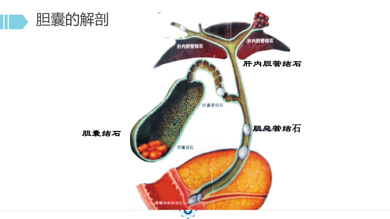 胆囊结石PPT课件10
