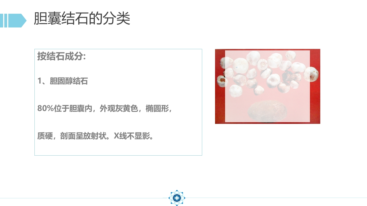 胆囊结石PPT课件14