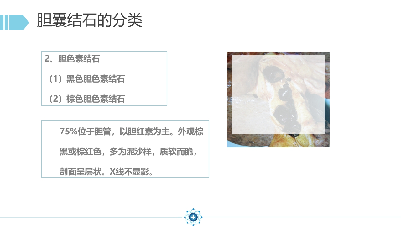 胆囊结石PPT课件15