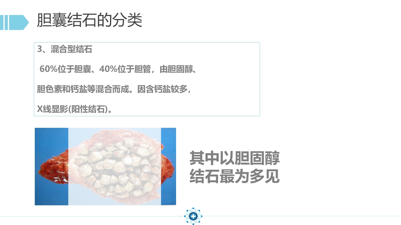胆囊结石PPT课件16