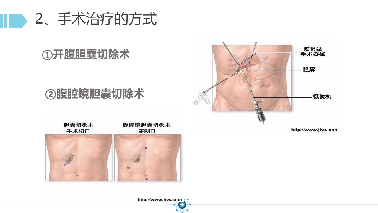 胆囊结石PPT课件29