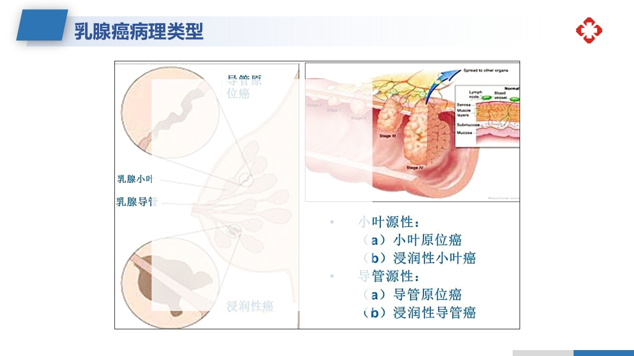 乳腺癌根治术后护理查房PPT课件7