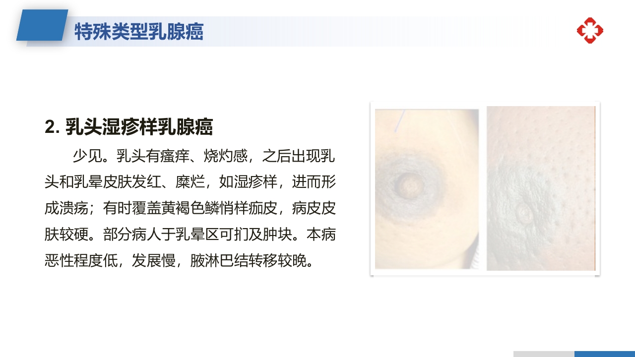 乳腺癌根治术后护理查房PPT课件9