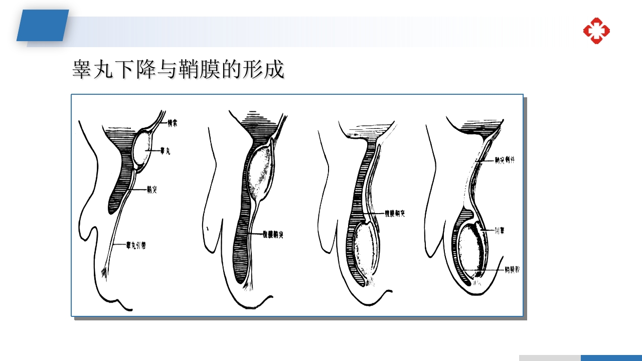 腹外疝病人的护理PPT课件14