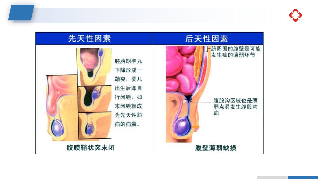 腹外疝病人的护理PPT课件15