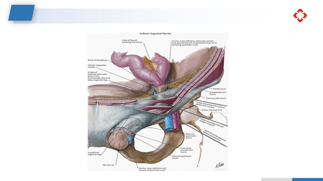 腹外疝病人的护理PPT课件16
