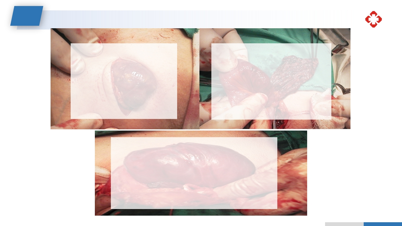 腹外疝病人的护理PPT课件17