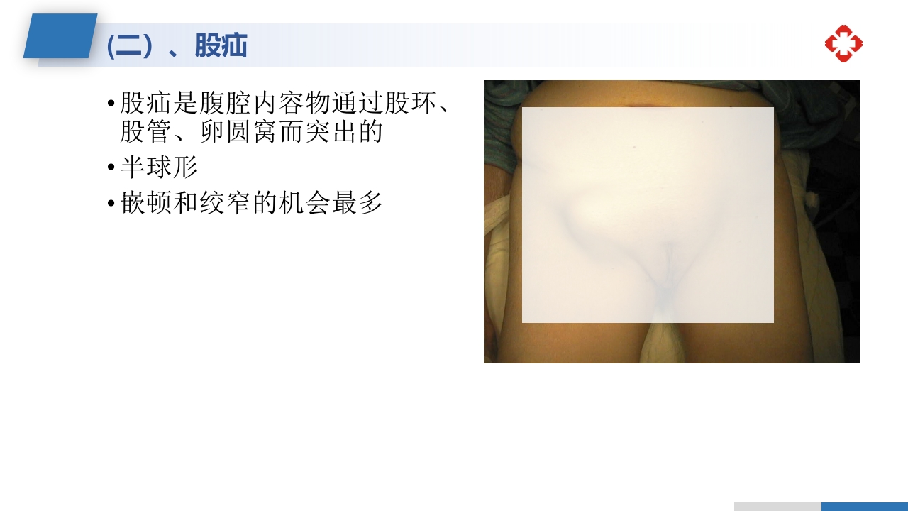 腹外疝病人的护理PPT课件20