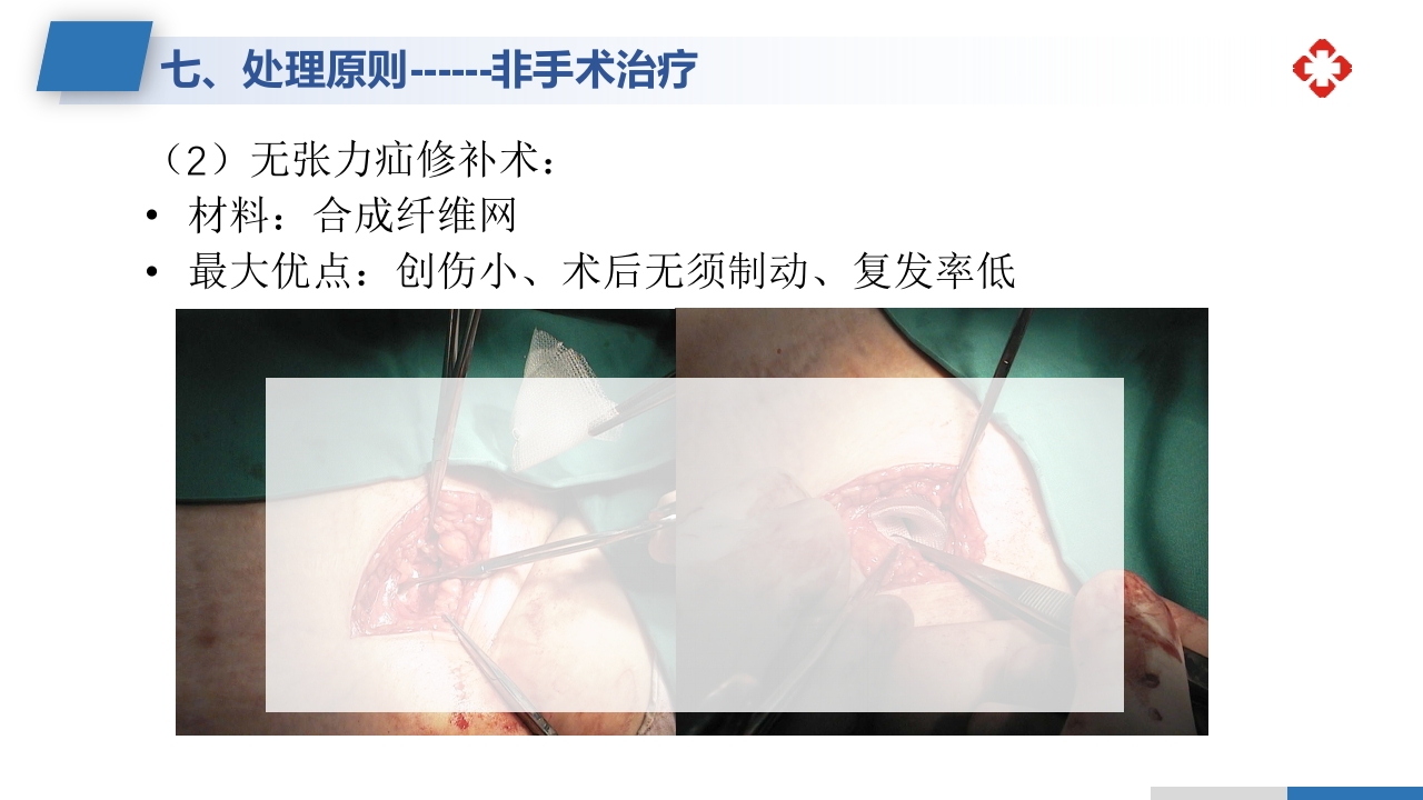 腹外疝病人的护理PPT课件26